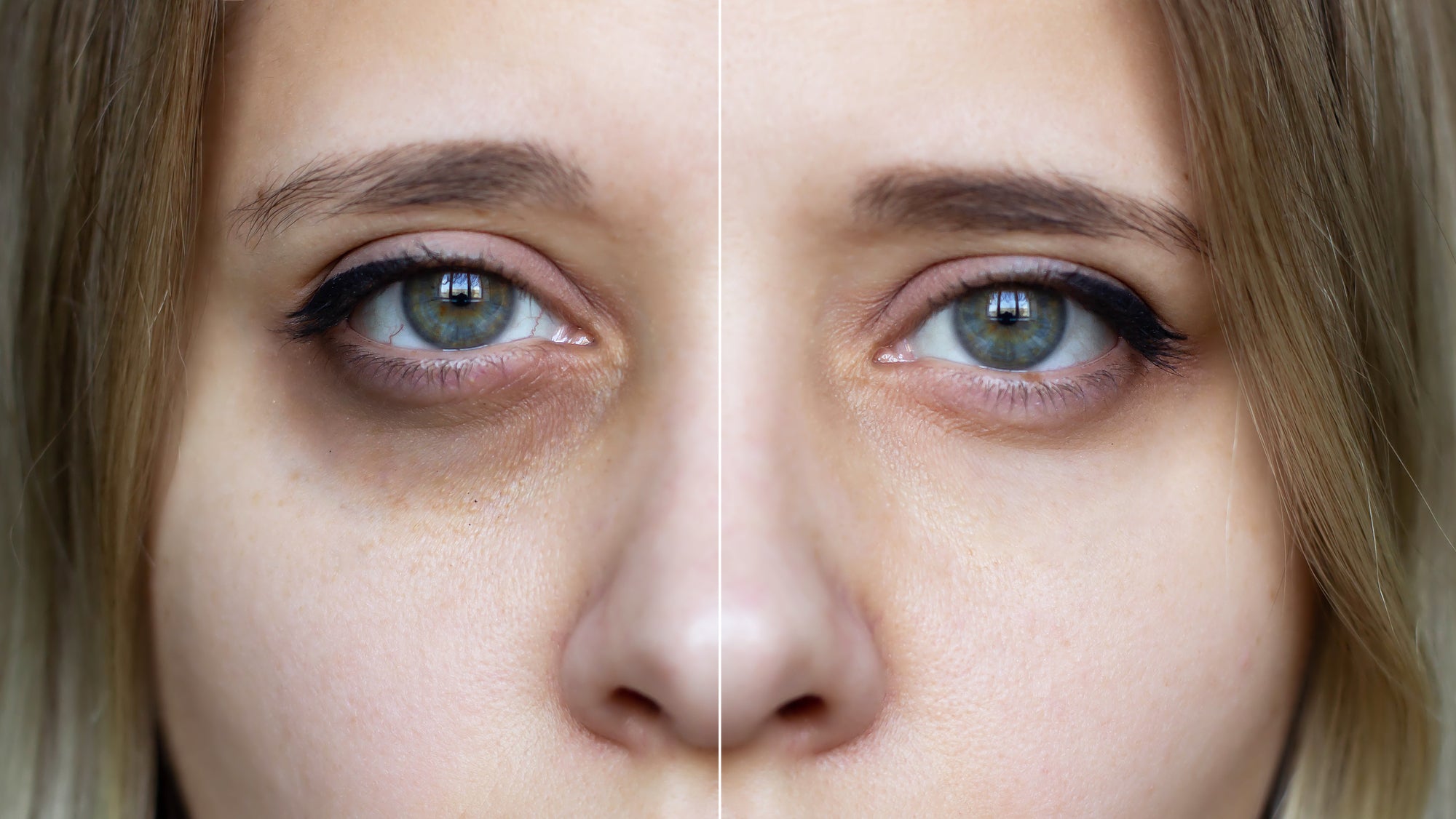 How to Get rid of dark circles under your eyes: Ultimate Skin Care Guide